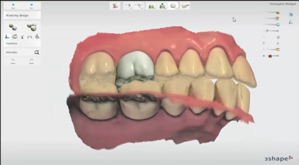 3Shape Trios Design Studio Software (Add on)